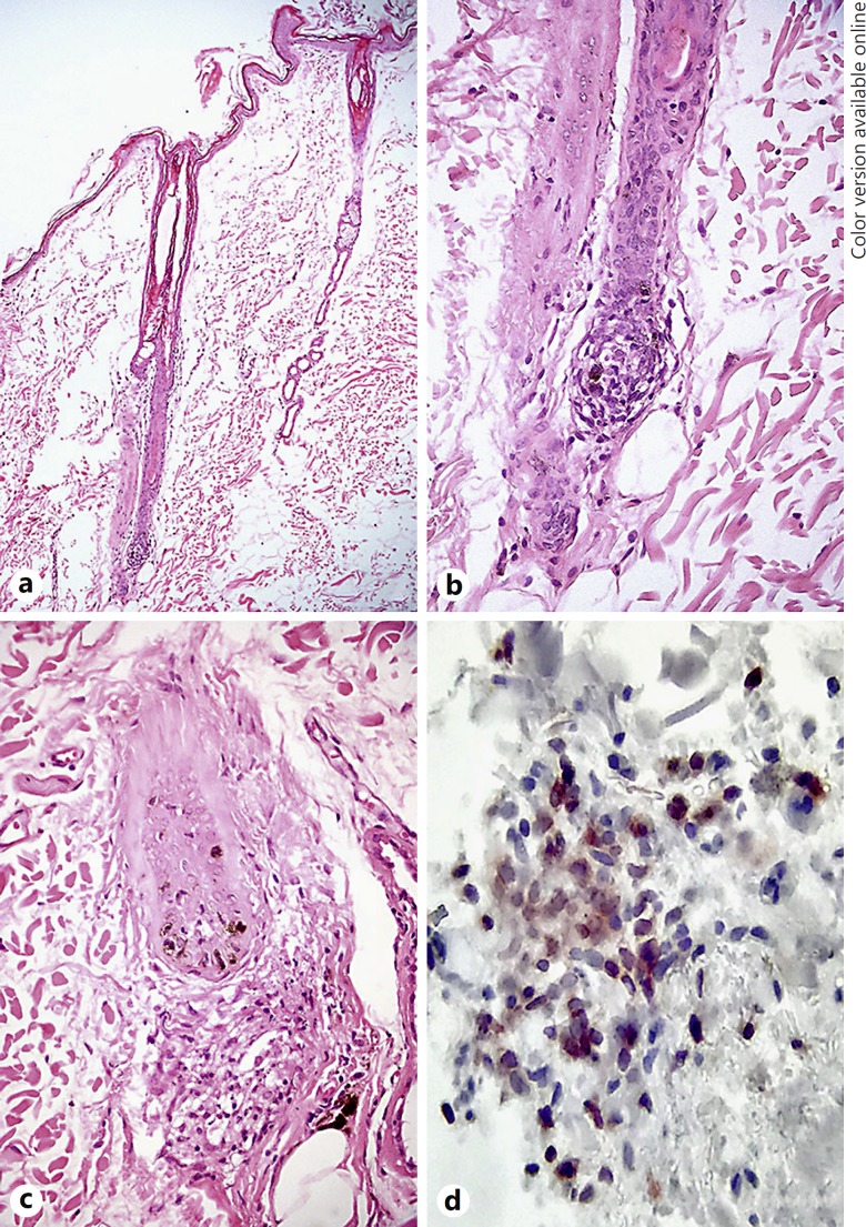 Biopsi alopecia areata