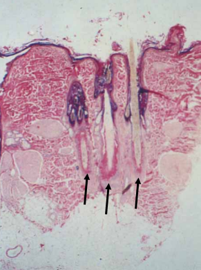 flame follicle